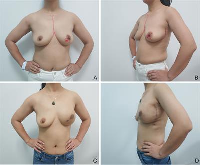 A Retrospective Study of Latissimus Dorsi Flap in Immediate Breast Reconstruction